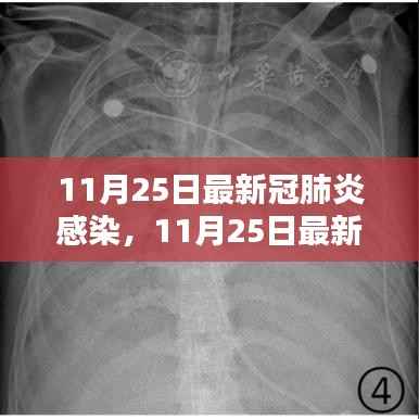 11月25日新冠肺炎感染最新形势分析,全面解析与某某观点阐述