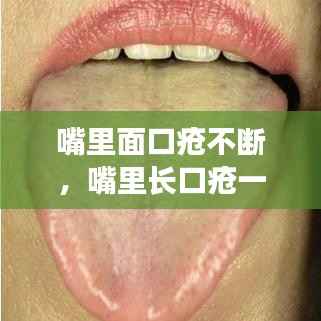 嘴里面口疮不断,嘴里长口疮一直不好